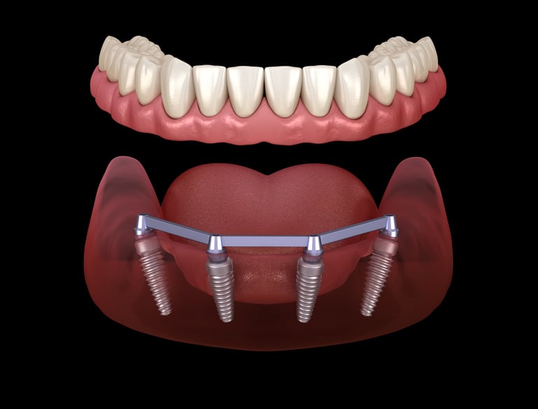 Mandibular prosthesis with gum All on 4 system supported by implants, medically accurate 3D illustration