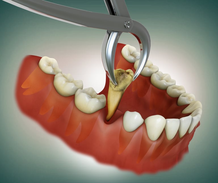 Caries damaged tooth being extracted with dental instrument