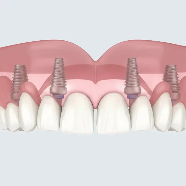 3D dental implant model showing metallic implant screws inserted in pink gum tissue with white artificial teeth crowns attached