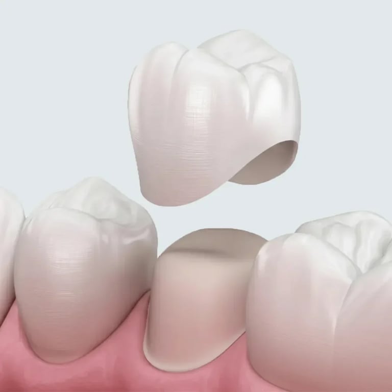 Dental illustration showing tooth restoration with ceramic crown being placed over a prepared tooth with pink gum tissue